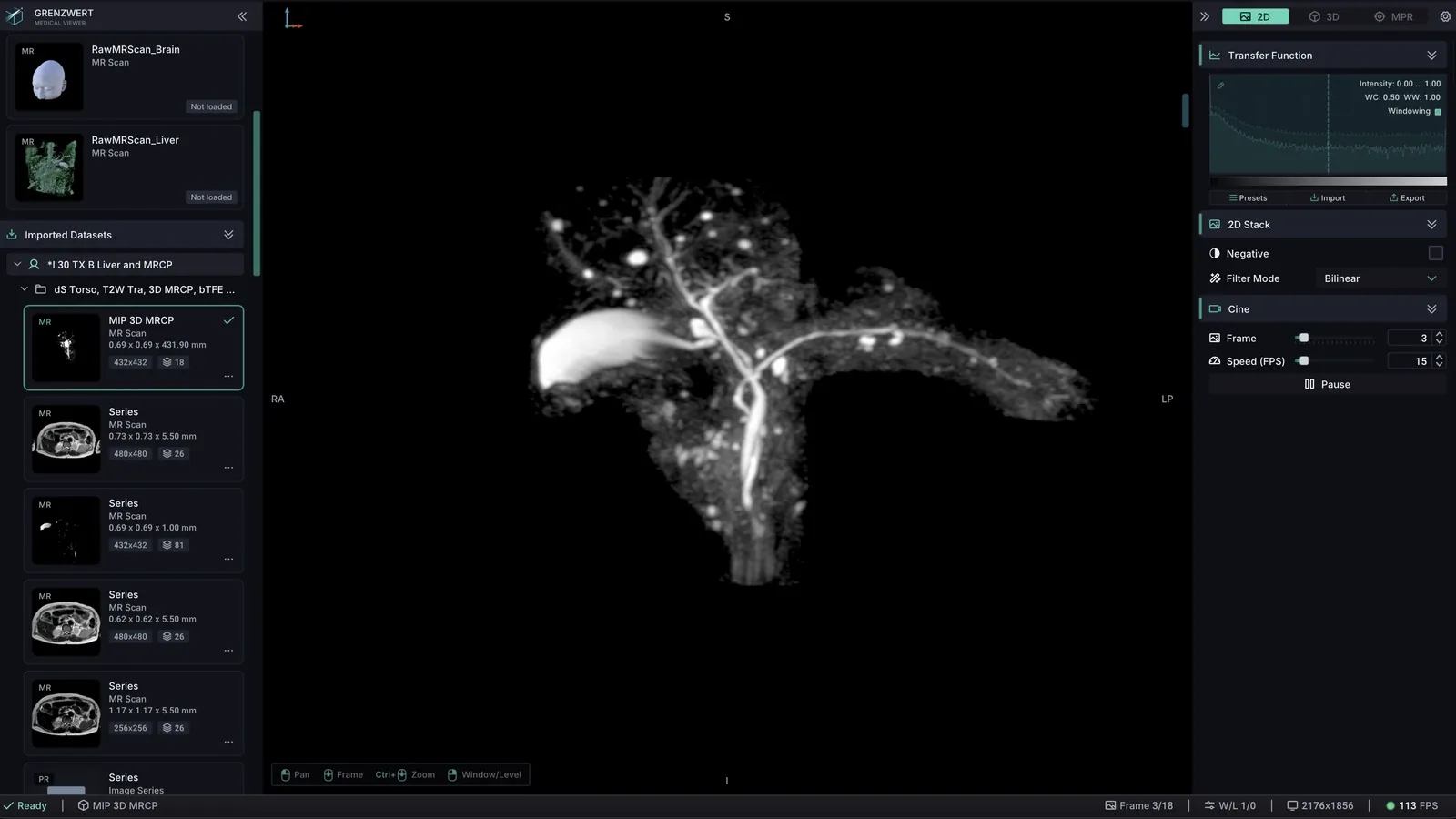 Grenzwert 2D stack view with an anatomical slice, transfer function, frame, and cine FPS controls