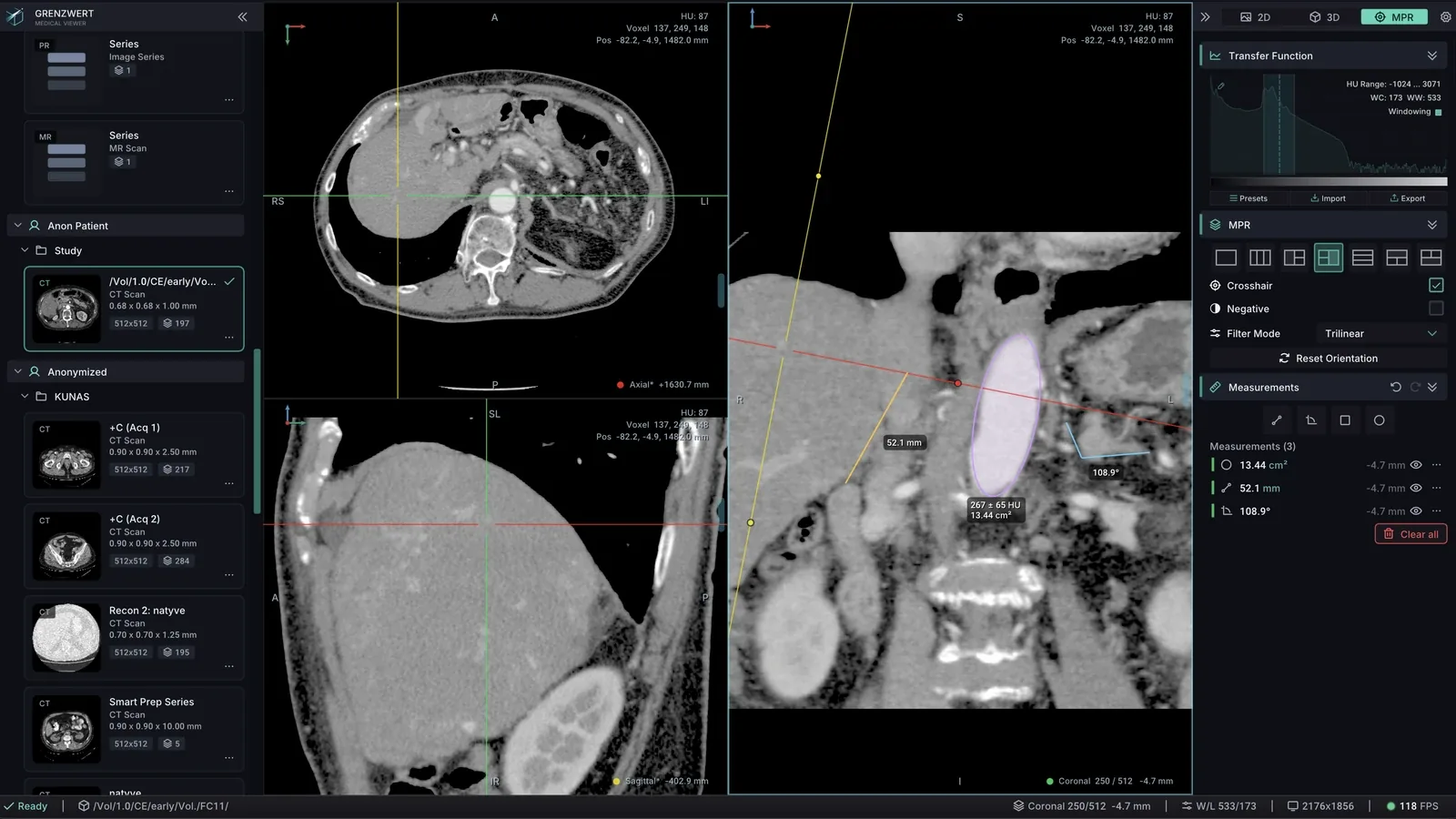 Grenzwert three-pane MPR view with crosshair, distance measurement, ROI, and HU readout