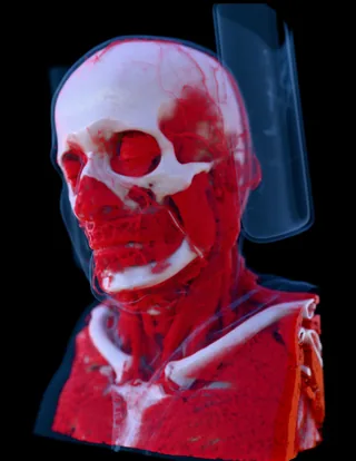 MANIX head CT scan rendered in 3D with bone and red soft tissue
