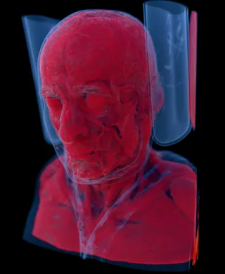 MANIX head CT scan rendered in 3D with transparent red tissue and clipping volume