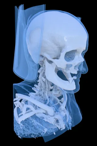 MANIX skull CT scan rendered in 3D with a blue bone preset side view