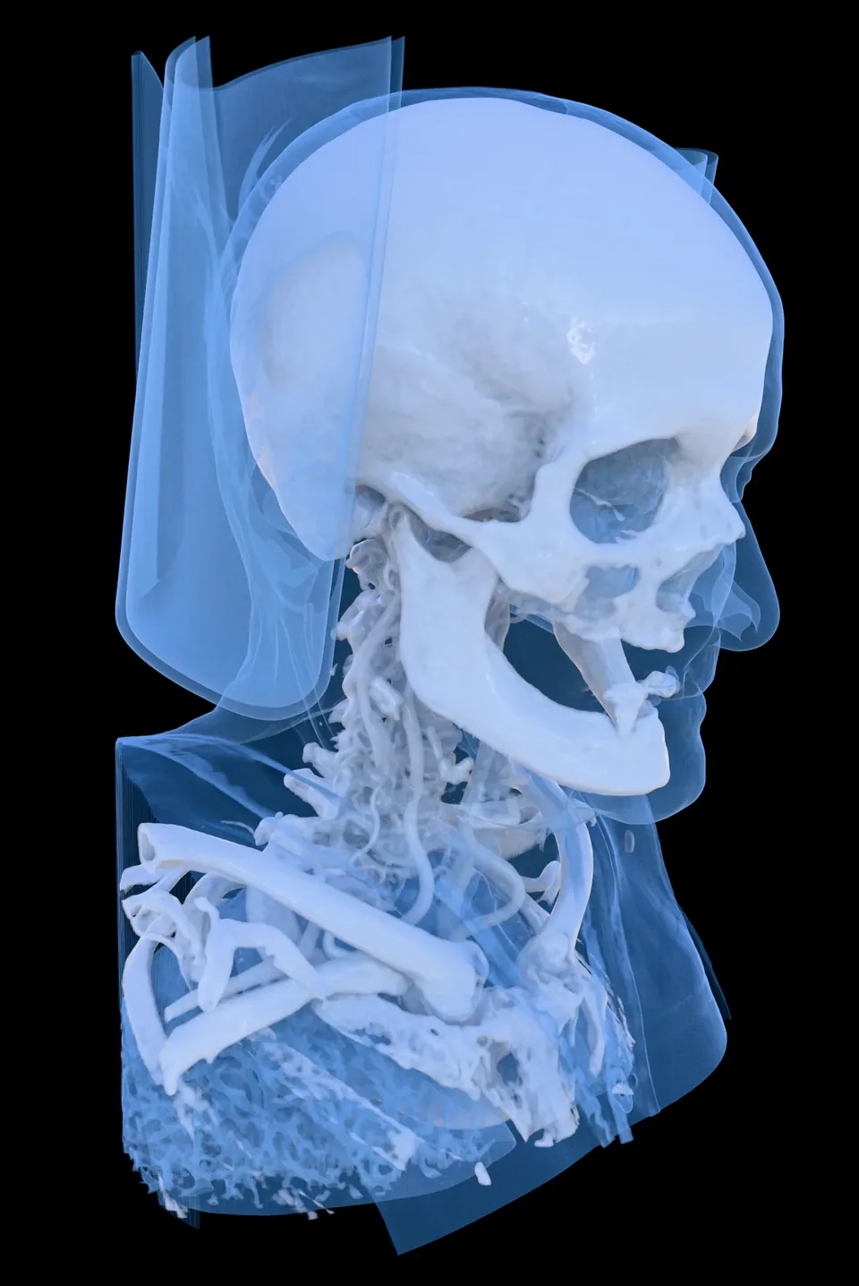 MANIX skull CT scan rendered in 3D with a blue bone preset side view